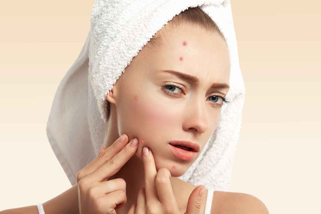 درمان جوش صورت در خانه و ۷ روش جلوگیری از جوش